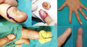 Caso 1: cirugía funcional del aparato ungueal (CFAU) de melanoma subungueal (MSU) amelanótico in situ con onicodistrofia completa del índice de la mano izquierda. Resultados a los 2 años.