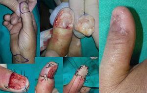 Caso 10: cirugía funcional del aparato ungueal (CFAU) de carcinoma epidermoide subungueal (CESU) moderadamente diferenciado, de 4mm de espesor, con onicodistrofia extensa del primer dedo de la mano derecha. Resultado a los 6 meses.