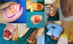 Caso 11: cirugía funcional del aparato ungueal (CFAU) de carcinoma epidermoide subungueal (CESU) moderadamente diferenciado, de 6mm de espesor, con tumoración excrecente sobre onicodistrofia del primer dedo del pie izquierdo. Resultado a los 4 meses.