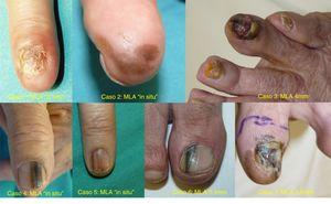 Clínica de los 7 casos de melanoma subungueal (MSU).