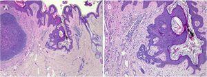 Tricoblastoma sobre nevus sebáceo. A(HE 4×): imagen panorámica. B(HE, 10×): en la periferia de la lesión tumoral se puede observar la presencia de cordones epiteliales que parten de la epidermis, con empalizada basal, hallazgos sugestivos de inducción folicular.