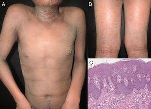 A y B) Dermatitis atópica eritrodérmica con eritema generalizado, escama fina y mayor involucro en los pliegues de flexión. C) La histopatología muestra paraqueratosis, acantosis y espongiosis leve (hematoxilina-eosina, x20).