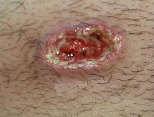 Lesión ulcerosa de 3×1,5cm de borde violáceo indurado, base necrótica y exudado fibrinopurulento en flanco derecho.