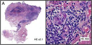 A) Hematoxilina-eosina ×2.1. B) Hematoxilina-eosina ×65.
