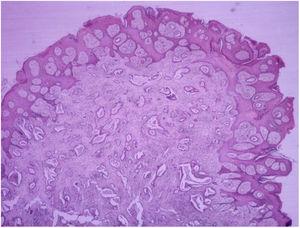 Piel con metástasis de adenocarcinoma ×20. Hematoxilina-eosina×40. Piel con metástasis de adenocarcinoma. Hay infiltración dérmica por proliferación epitelial maligna distribuida en patrón glandular irregular, con pleomorfismo celular.