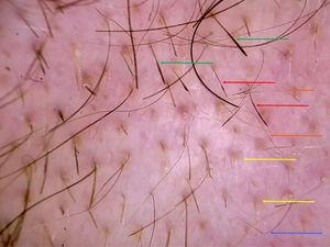 Imagen con DermLite® II Hybrid (3Gen™) del borde de la placa de alopecia. Flechas rojas: pelos con constricciones de Pohl-Pinkus o moniletrix-like. Flechas verdes: pelos peládicos o en forma de signo de exclamación el extremo distal engrosado. Flechas amarillas: puntos amarillos. Flechas naranjas: vellos cortos. Flecha azul: pelo angulado.