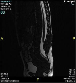 Columna espinal amplia de CSF, compatible con médula espinal no anclada.