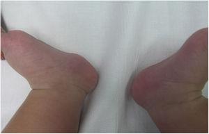 Imagen clínica de un hamartoma fibrolipomatoso en una niña de 5 meses. Obsérvese una tumoración de color piel y consistencia blanda en la región precalcánea del talón izquierdo.