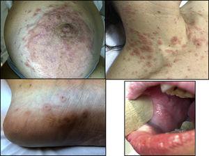 Lesiones tipo eritema exudativo multiforme en la piel y erosiones orales.