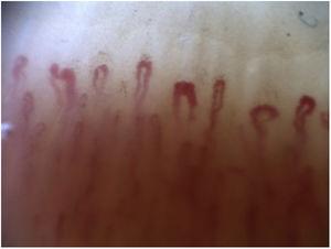 Patrón temprano de esclerodermia. Pocos capilares gigantes, sin evidencia de pérdida capilar, con distribución capilar bien conservada.