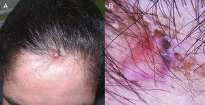 A) Nódulo color piel con una pápula de pigmentación azulada en su superficie. B) Dermatoscopia. Área rojo asalmonada, vasos lineales y pigmentación azul homogénea.