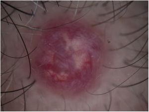 Dermatoscopia que alterna tonalidades eritematosas intensas en la periferia con vascularización prominente y zonas blanquecinas irregulares en el centro.