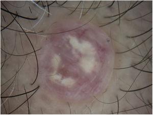 Mediante el estudio dermatoscópico de contacto prácticamente desaparece el componente vascular tan notable y predominan las estructuras blanco-grisáceas sobre un fondo rosado pálido.