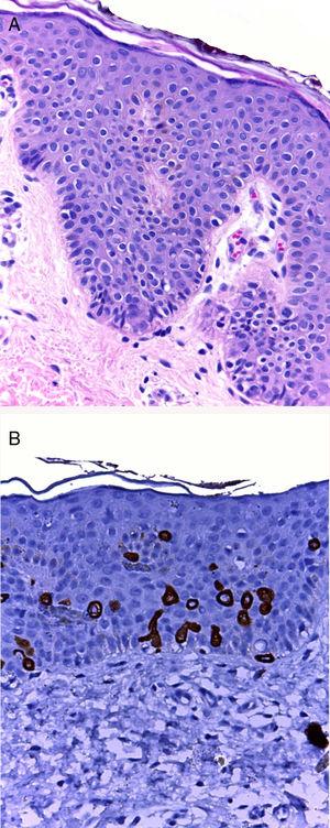 A) La tinción con hematoxilina-eosina ×10 muestra escasas y dispersas células redondas con citoplasma amplio y claro a nivel de la capa basal de la epidermis. Sin cambios en la dermis. B) Inmunohistoquímica CK7 muestra a las células claras teñidas, la mayoría están localizadas en la capa basal y algunas a nivel suprabasal.