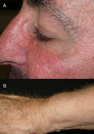 A) Tricomegalia de pestañas e hipertricosis facial por erlotinib (anti-EGFR). B) Hipertricosis en el brazo del mismo paciente. Cortesía de la Dra. M.P. Garcia-Muret.