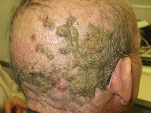 Reacción folicular sobre cuero cabelludo por cetuximab (anti-EGFR), que recuerda a dermatosis pustulosa erosiva del cuero cabelludo.
