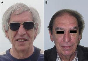A) Paciente con el pelo canoso. B) Mismo paciente con repigmentación del pelo tras tratamiento con nivolumab (anti-PD1). Cortesía de la Dra. N. Rivera.