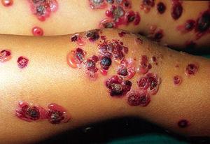 Lesiones cutáneas en un niño con dermatosis ampollar IgA lineal. La fotografía muestra numerosas ampollas tensas que se disponen en rosetas con una costra central.