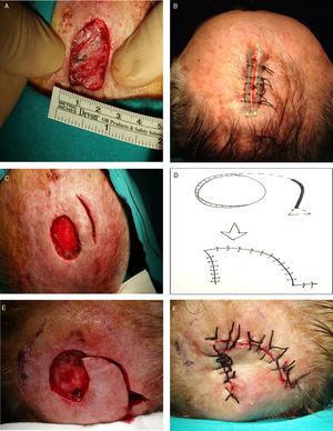 Reconstrucción de defectos con distancia de aproximación menor de 2cm. (A) Medida de la distancia de aproximación. Si esta distancia es menor de 1cm se aconseja sutura reforzada con sonda (B). Si está entre 1 y 2cm, realizar una incisión de descarga (C) y si no cierra ampliación al colgajo de rotación (D-F).