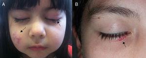 A)Niña con nódulos eritematosos en la mejilla derecha y chalazión en el párpado superior izquierdo. B)Niño con lesión eritematosa en el párpado inferior del ojo derecho.