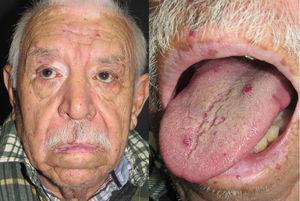 Múltiples telangiectasias puntiformes faciales y en mucosa oral en un paciente que además de HHT padece vitíligo.
