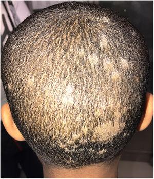 Tinea capitis en un niño de 5 años de raza negra, nacido en España. Se observan múltiples placas alopécicas con escama grisácea en el cuero cabelludo.