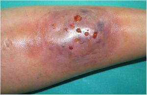 Lesión cutánea compatible con pioderma gangrenoso en la parte anterior de la pierna izquierda. Imagen previa al tratamiento combinado con ustekinumab y ciclosporina.