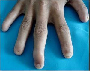 Ausencia completa de las uñas de los dedos 4.° y 5.° de la mano derecha con deformidad en garra del tercer dedo.