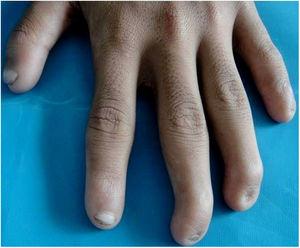 Anoniquia del dedo anular y meñique de la mano izquierda con deformidad en garra de los dedos corazón y anular.
