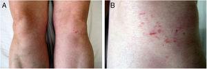 Imágenes clínicas. A)Pápulas eritemato-parduzcas en ambas rodillas. B)A mayor detalle, lesiones de aspecto liquenoide, algunas lineales, en rodilla izquierda.