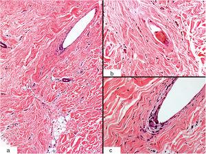 Características histológicas (tinción H-E): dermis esclerótica con colágeno denso, de aspecto cicatricial (a) (×10); detalle de un folículo piloso roto (b) (×40); células gigantes multinucleadas perifoliculares (c) (×40).