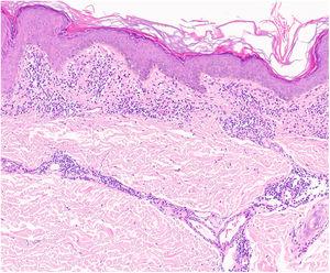 Imagen histopatológica de liquen aureus. Infiltrado en banda en dermis papilar y perivascular superficial.