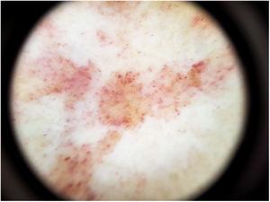 Dermatoscopia de la enfermedad de Schamberg. Pigmentación rojo-cobriza en el fondo y glóbulos rojos.