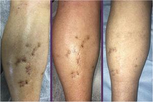 Evolución de las pápulas-nódulos azulados en la pierna derecha: al inicio del tratamiento con timolol gel al 0,5%, a las 8 semanas y a los 3 meses.