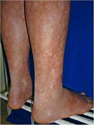 Micosis fungoide tipo capilaritis en una adolescente.