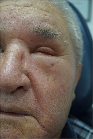 Edema facial con fóvea y eritema predominantemente en la hemicara izquierda.