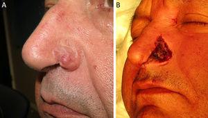 A) Recidiva de carcinoma basocelular en ala nasal izquierda. B) Defecto posquirúrgico tras la extirpación mediante cirugía micrográfica de Mohs.