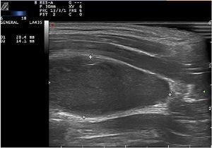 Modo B, corte longitudinal, revela una lesión hipoecogénica ovalada subyacente al músculo esternocleidomastoideo.