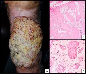 A) Tumor verrugoso ulcerado en pierna izquierda. B) Nidos de células de aspecto escamoso infiltrando dermis (H&E ×10). C) Pleomorfismo nuclear (H&E ×40).