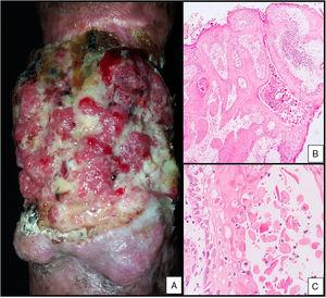 A) Tumor verrugoso ulcerado antebrazo derecho. B) Carcinoma escamoso infiltrante bien diferenciado (H&E 10×). C) Mitosis, pleomorfismo nuclear (H&E ×40).