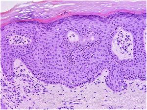 Biopsia cutánea con hiperqueratosis, acantosis y capa basal epidérmica con células en empalizada. Se aprecia focalmente zona acelular ancha justo por encima de los núcleos de la capa basal.