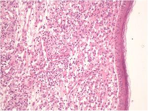 Células de Langerhans con un citoplasma eosinófilo, núcleos lobulados o con hendidura; además se observan histiocitos con un citoplasma claro y abundante, así como linfocitos a nivel de la dermis.