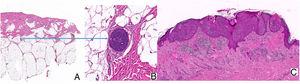 A. HEx2. Nidos tumorales de origen epidérmico que invaden la dermis papilar, reticular y focalmente la hipodermis. B. HEx20. Se observa un vaso linfático localizado en hipodermis con metástasis. C. HEx15. Nidos de células tumorales infiltrando la epidermis.