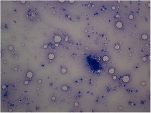 Células epiteliales malignas. Extensión de la PAAF, tinción Giemsa.