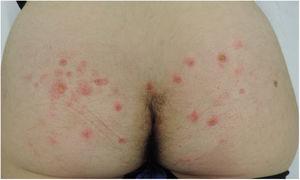 Lesiones papuloeritematosas en glúteos con signos de excoriación.