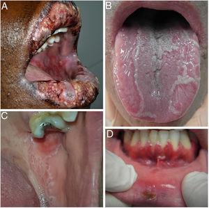 A. Eritema multiforme major con afectación de la mucosa oral. B. Lengua geográfica. C. Reticulado blanquecino en liquen plano oral. D. Primoinfección herpética.