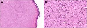 A) Proliferación de células fusiformes en dermis con zona de Grenz (hematoxilina-eosina×5.85). B) Células fusiformes con núcleos ovalados y presencia de algún mastocito (hematoxilina-eosina×30).