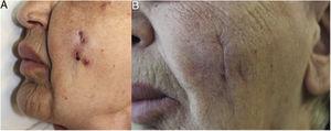 A) Se observa el área edematosa, con pérdida de las arrugas de expresión y orificios de salida de tractos fistulosos, mientras que en B) se constata una disminución del edema y cicatrices de los tractos.