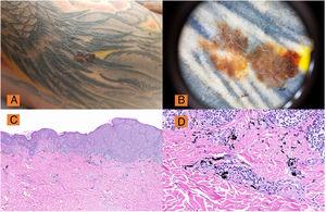 A) Lesión pigmentada con alteración de los criterios clínicos ABCD en el brazo derecho sobre tatuaje. B) Dermoscopia (DermLite® DL3) ×10: Lesión melánica con áreas de regresión, retículo pigmentado roto y atípico, asimetría y policromía manifiesta, confirmada histológicamente con melanoma de extensión superficial, Breslow 0,25mm. C) H&E, ×2: Panorámica de melanoma de extensión superficial con distribución pagetoide. D) Melan A: Detalle de tinción de melanoma y pigmento en dermis superficial.