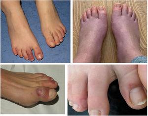 Lesiones pernióticas y edema en las manos y los pies.
